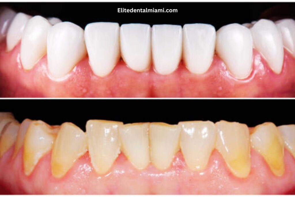 Deep Cleaning Teeth before And After