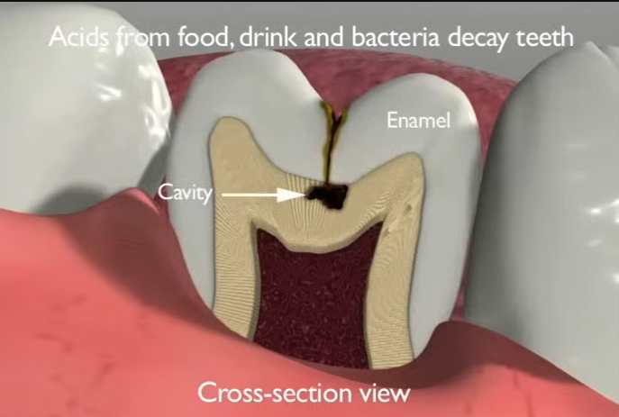 Understanding The Effects On Tooth Enamel
