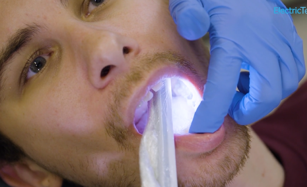 Teeth Whitening Permanent