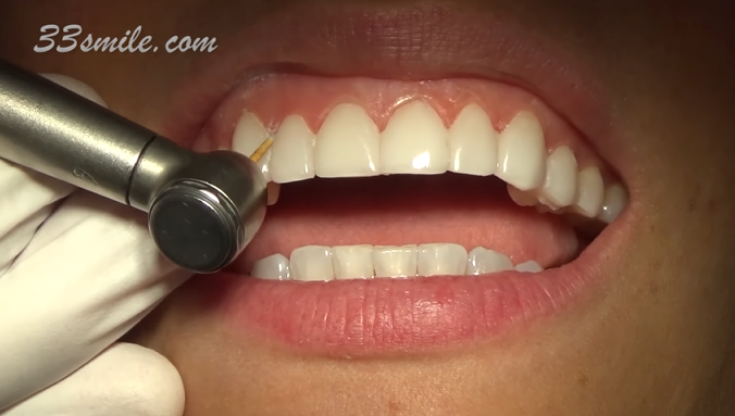 Teeth Whitening Permanent,Teeth Whitening,Permanent