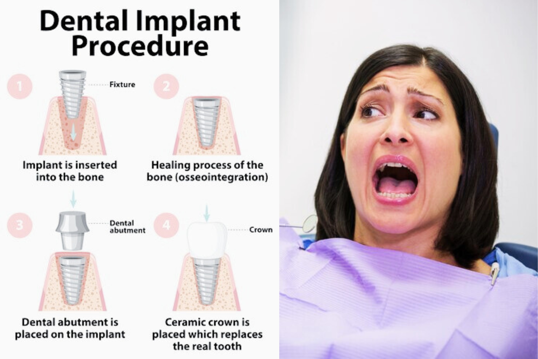 what are the 3 stages of dental implants