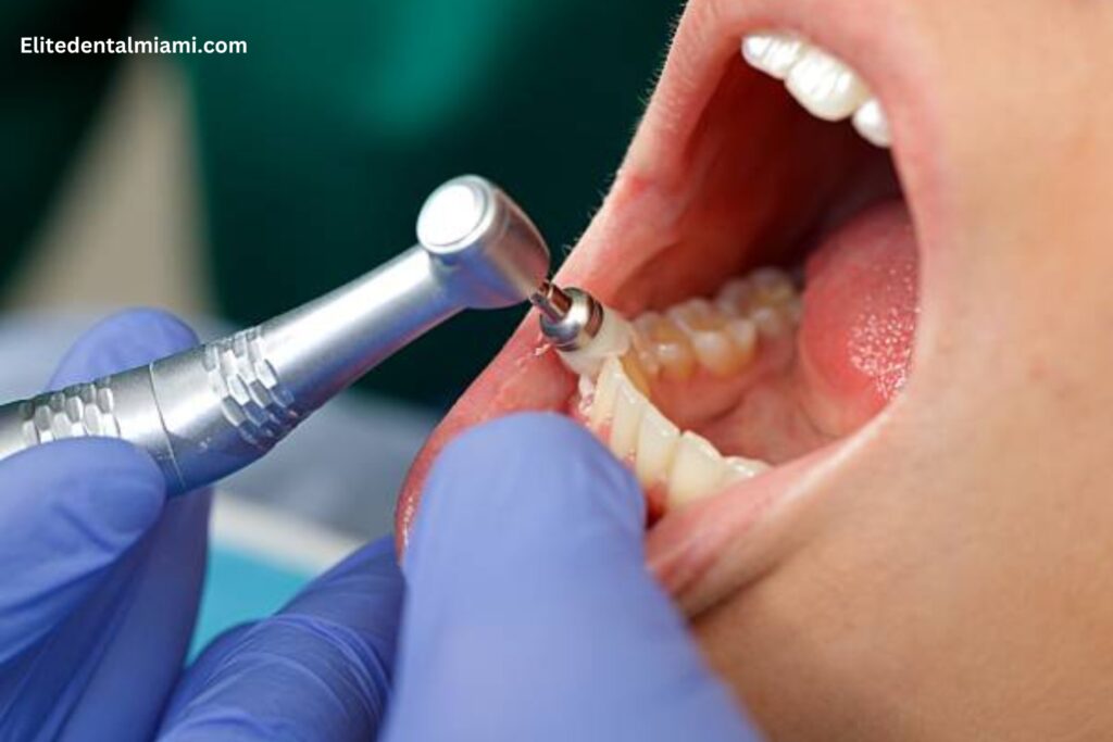 What can dental cleaning damage teeth